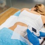 The Essential Guide to CoolSculpting in Vancouver