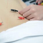 Electroacupuncture: A Modern Twist on Traditional Healing