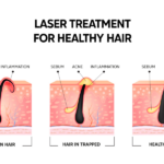 The science behind laser treatments: Revitalizing hair growth in individuals with hair loss
