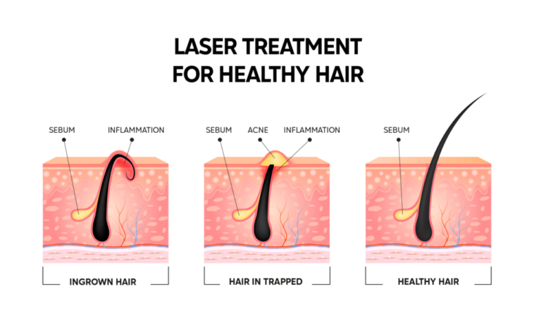 The science behind laser treatments: Revitalizing hair growth in individuals with hair loss